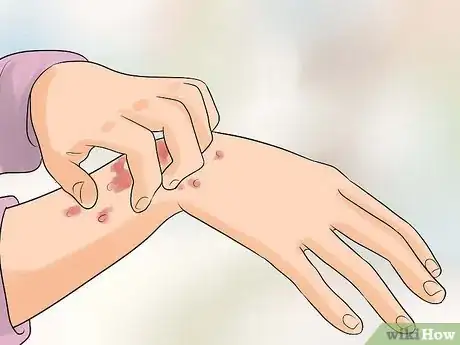 Image titled Identify an HIV Rash Step 1