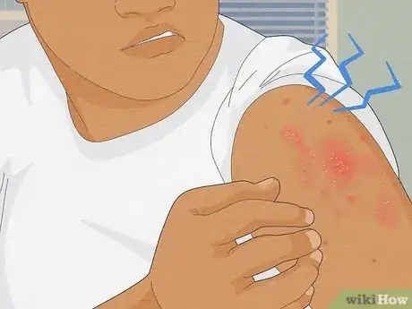 Image titled Recognize Scabies Rash Step 2