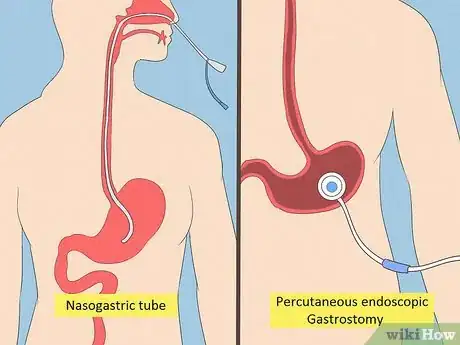 Image titled Fix Malnutrition Step 13