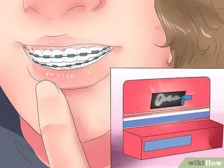 Image titled Alleviate Orthodontic Brace Pain Step 7