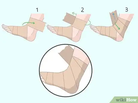 Image titled Wrap an Ankle with an ACE Bandage Step 5