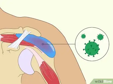 Image titled Treat Subacromial Bursitis Step 4