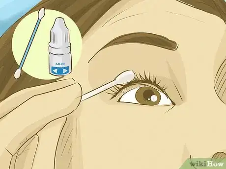 Image titled Get an Eyelash Out of Your Eye Step 6