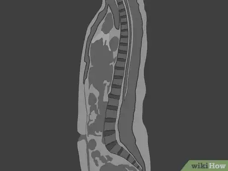 Image titled Read a Lumbar MRI Step 09