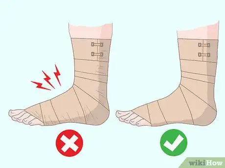 Image titled Wrap an Ankle with an ACE Bandage Step 8