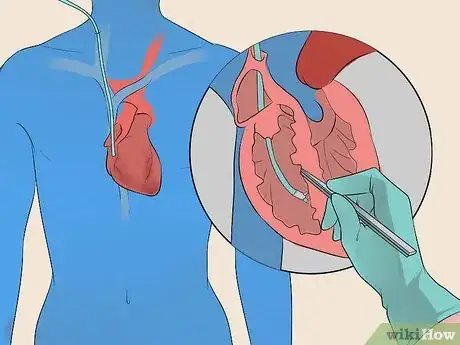 Image titled Treat Tachycardia Step 8