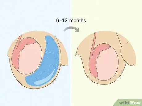 Image titled Cure a Hydrocele Step 2