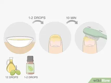 Image titled Get Rid of Nail Fungus Step 1