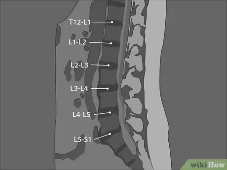 Image titled Read a Lumbar MRI Step 06