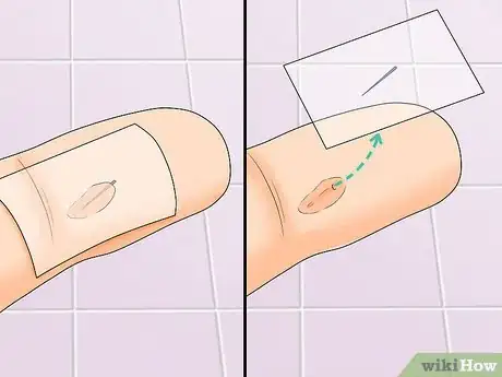 Image titled Remove Splinters in Children Step 15