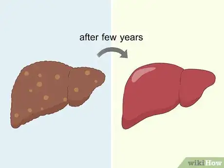 Image titled Treat Liver Fibrosis Step 19
