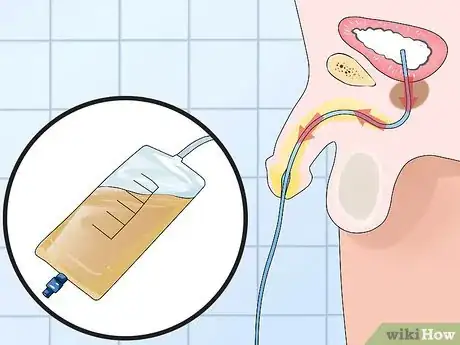 Image titled Use a Catheter Step 14