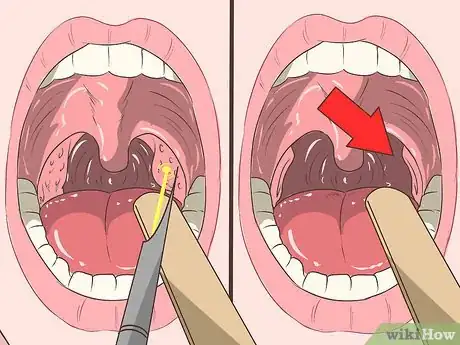 Image titled Remove Tonsil Stones (Tonsilloliths) Step 17