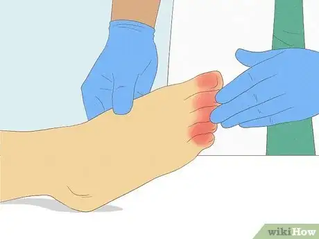 Image titled Treat Trench Foot Step 15