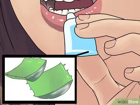 Image titled Treat a Fat Lip Step 8