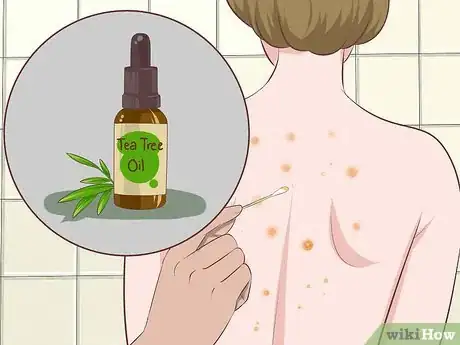 Image titled Get Rid of Back Acne Fast Step 7