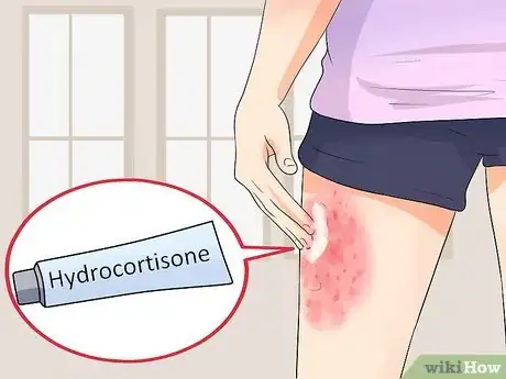 Image titled Get Rid of Eczema and Staph Step 4