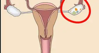 Know if You Have an Ovarian Cyst