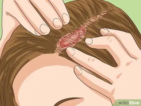 Image titled Diagnose Scalp Psoriasis Step 1