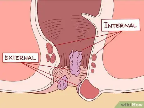 Image titled Care for Hemorrhoids Postpartum Step 26