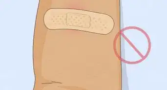 Properly Place a TB Skin Test