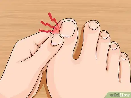 Image titled Relieve Ingrown Toe Nail Pain Step 2