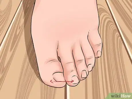 Image titled Avoid Ingrown Toenails Step 2