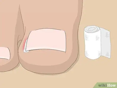 Image titled Relieve Ingrown Toe Nail Pain Step 17