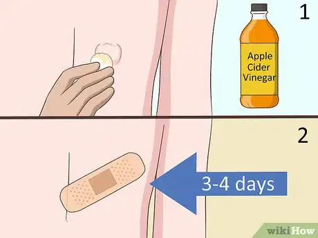 Image titled Remove a Cyst on Your Back Step 13