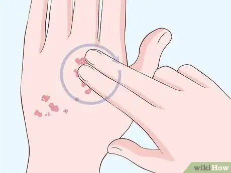 Image titled Heal Scabies Scars Step 1