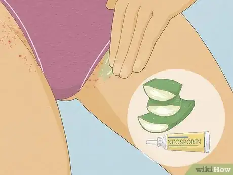 Image titled Get Rid of Razor Bumps in the Bikini Area Step 1