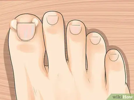 Image titled Tell if You Have an Ingrown Toenail Step 3