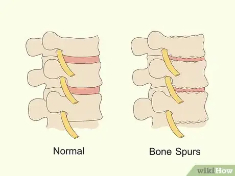 Image titled Know if You Have a Pinched Nerve Step 10