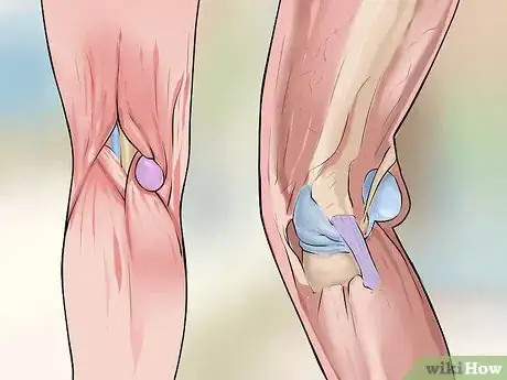 Image titled Cure a Baker's Cyst Step 1
