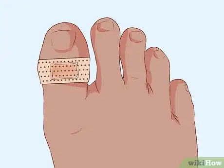 Image titled Bandage Fingers or Toes Step 11