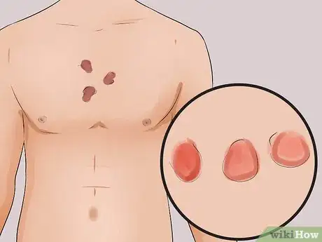 Image titled Tell the Difference Between Eczema and Psoriasis Step 1