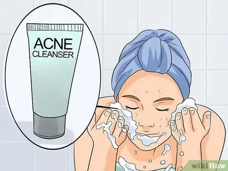 Image titled Decrease the Size of a Pimple Overnight Step 11