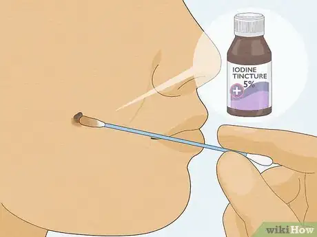 Image titled Remove a Mole with Iodine Step 7