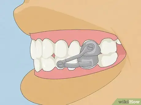 Image titled Straighten Your Teeth Without Braces Step 17