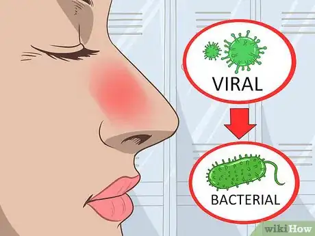 Image titled Tell a Viral from a Bacterial Infection Step 7