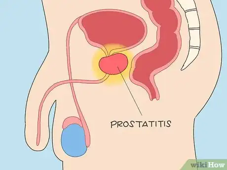 Image titled Reduce Prostate Pain Step 3