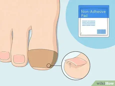 Image titled Protect Toenails when Running Step 5