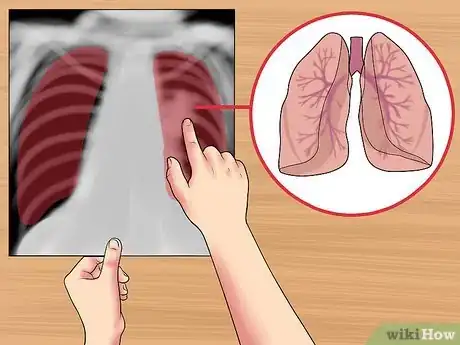 Image titled Read a Chest X Ray Step 19