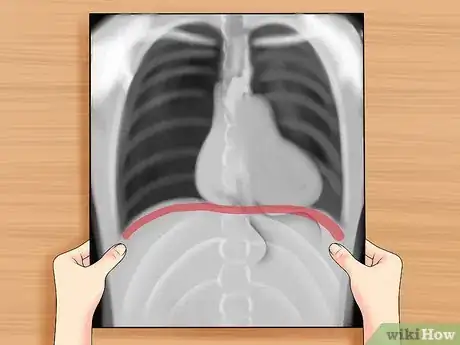 Image titled Read a Chest X Ray Step 17