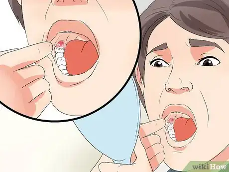 Image titled Tell if Your Wisdom Teeth Are Coming in Step 3