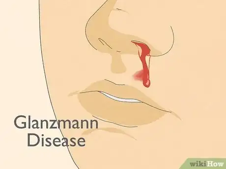 Image titled Know if You Have Internal Bleeding Step 15