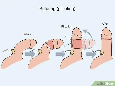 Image titled Treat Peyronie's Disease Step 07
