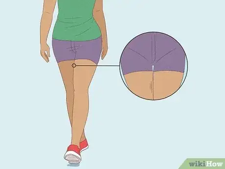 Image titled Get Rid of a Rash Between Your Legs Step 5