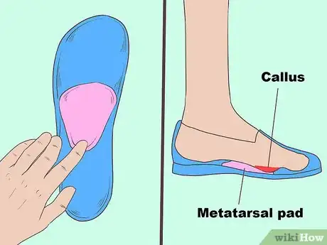 Image titled Cure Metatarsalgia Step 7