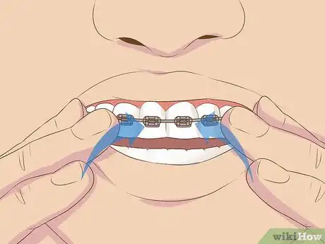 Image titled Make Fake Braces or a Fake Retainer Step 10